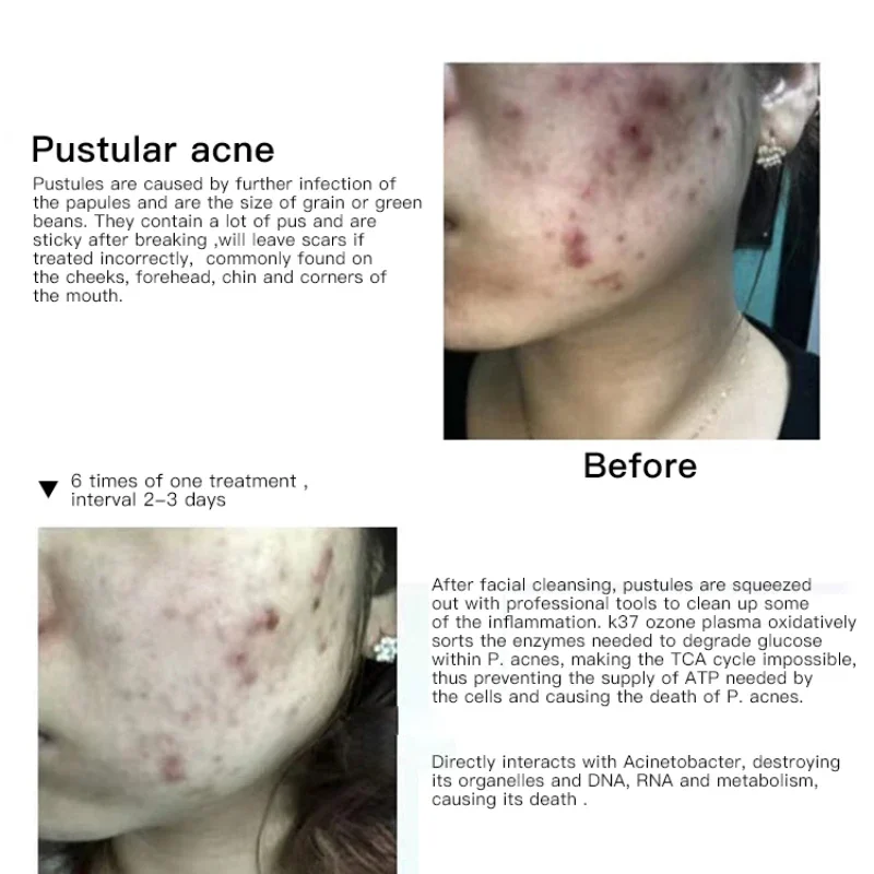 ozone plasma pen acne treatment device beauty instrument Blemish Removal Dead Skin Removal Skin Rejuvenation Skin Mouisture