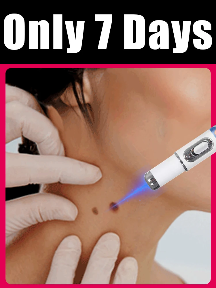 Blue Light Pen Maximum Strength Common and Plantar Wart Falling off warts care tool