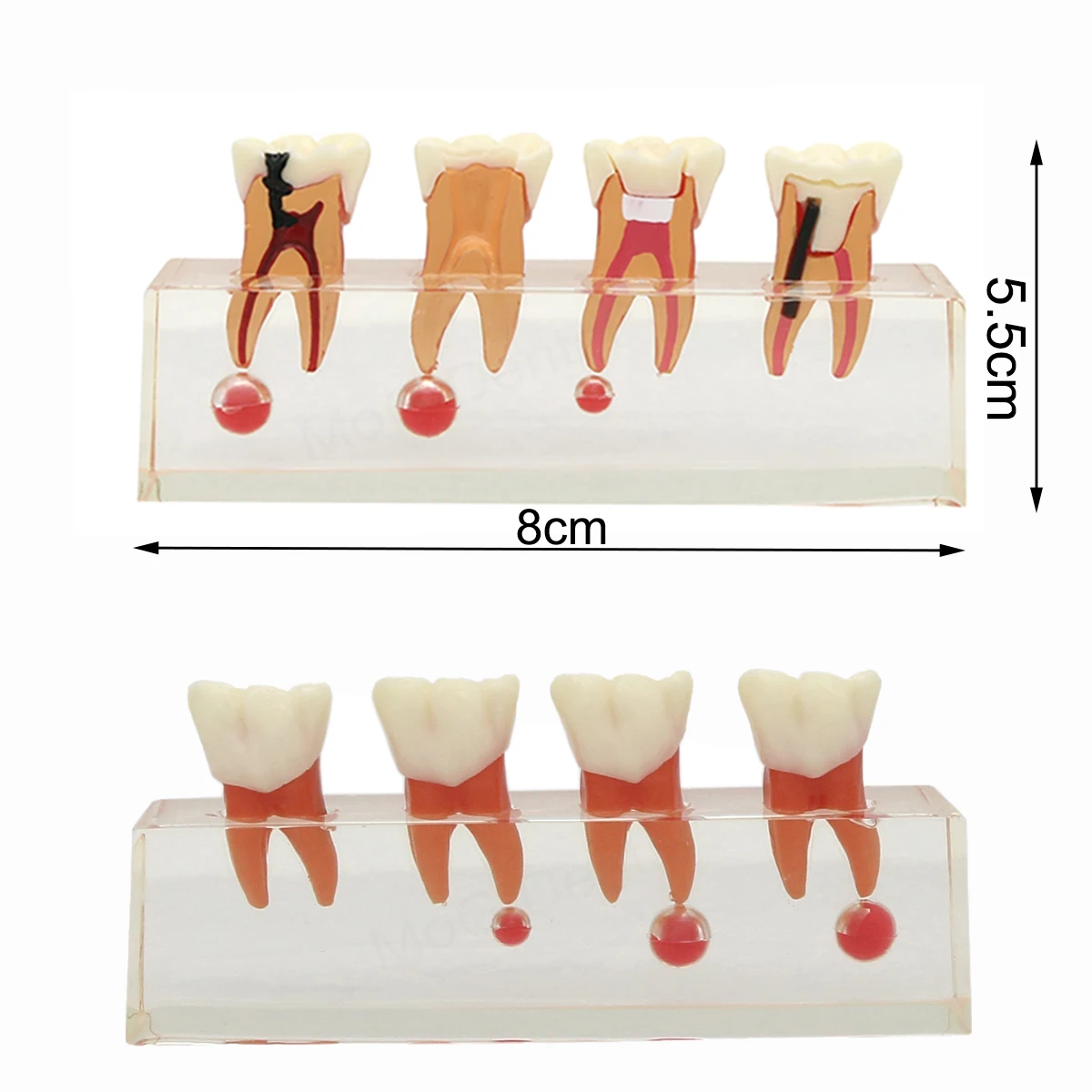 Dental Models with Endodontic Pathological Treatment Dental Teaching Model for Dentistry Root Canal Anatomy Clear Study Demo