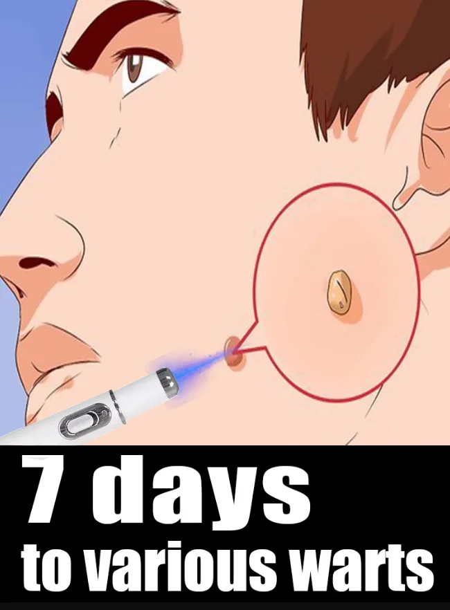 

Outil Wart Blue Light, а также изысканные уборы sur les