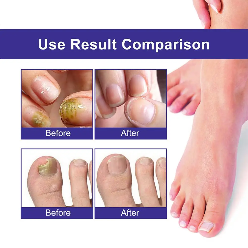 Anti Infection Onychomycosis Repair Serum, Tratamento Fungoso do prego, Essência do cuidado dos pés, Toe Fungal Removal, 10Pcs