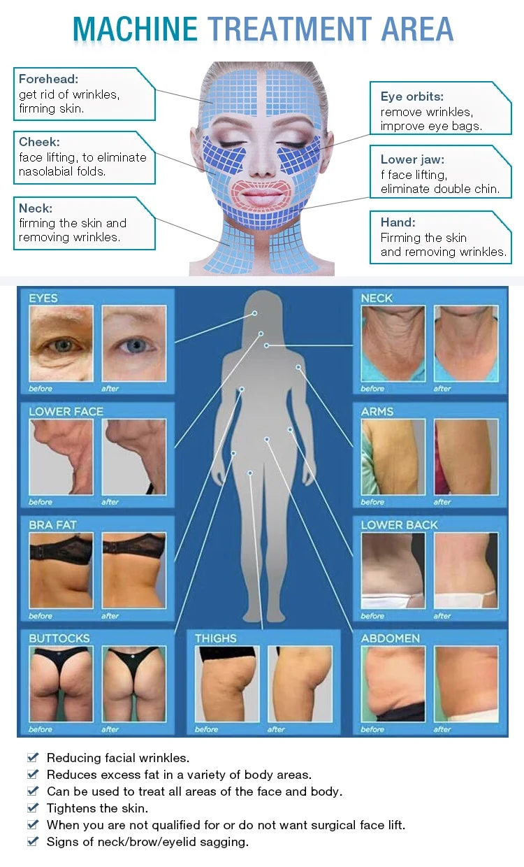 Ultra 360 Hautstraffung, Kollagenpistole, Cellulite-Reduktion, 2-in-1, unipolare Straffung der Haut, Körper, Abnehmen, Facelifting, Schönheitsmaschine – Detail 9
