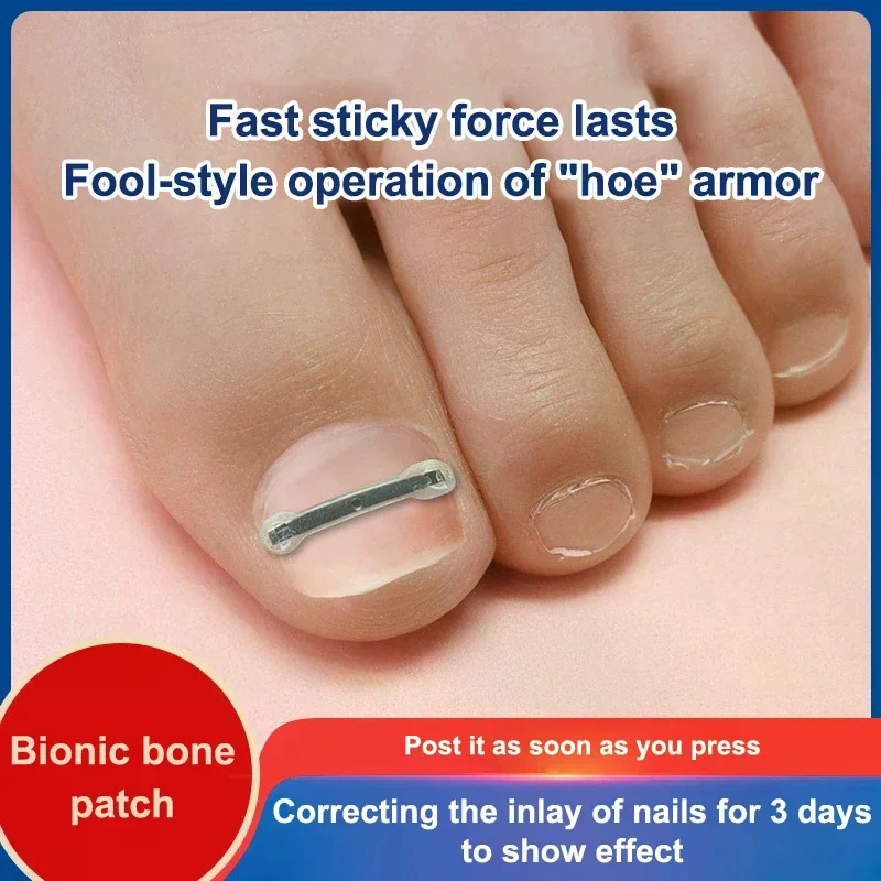 12個入り陥入爪治療キット、4つのマルチサイズ、チタン合金陥入爪矯正ツール、湾曲した爪矯正用