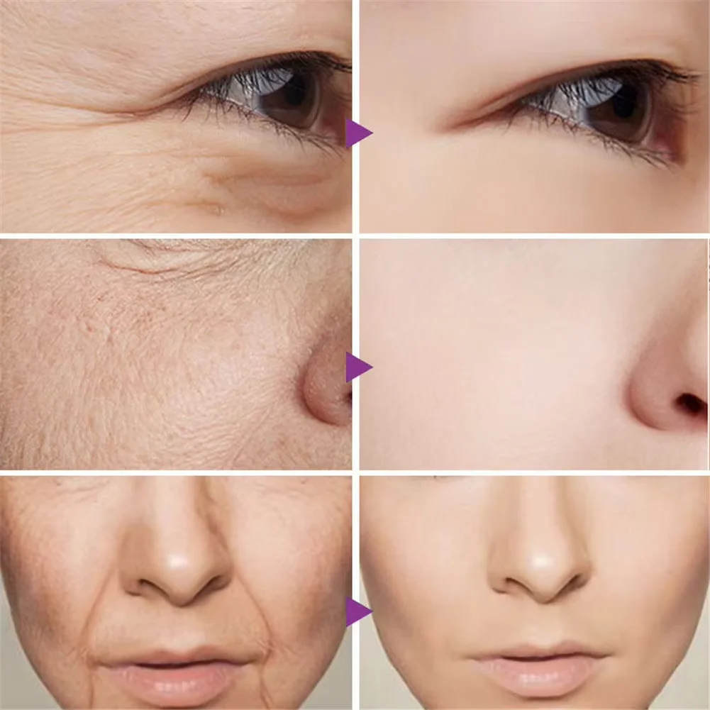 Collageen Eiwit Patche Instant Rimpel Remover Serum Set Lifting Verstevigende Oplosbare Absorbeerbare Gezicht Filler Anti-aging Huidverzorging