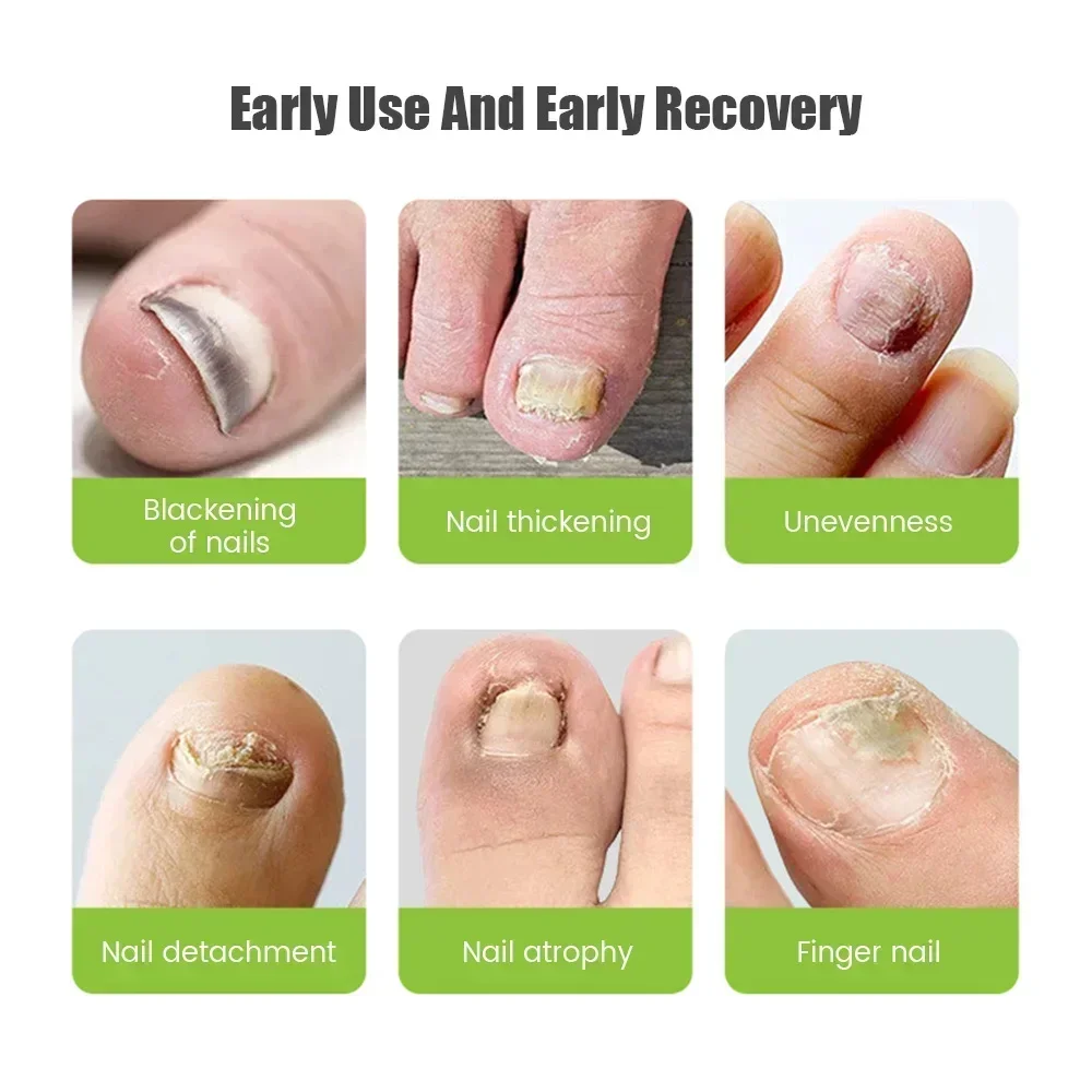 Nail Fungus Treatment Tools Fungal Nail Treatment Anti-Equipment Onychomycosis Therapy Remove Fungal Toenail Fungal Infection