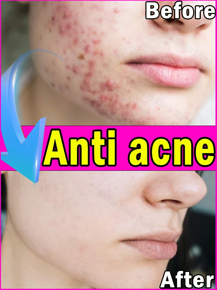 

For anti-acne