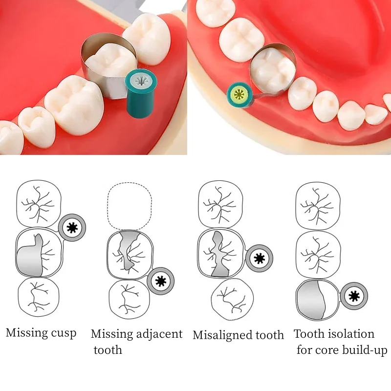 50 sztuk/pudło opaski matrycowe dentystyczne matryca stalowa dwustronna konturowana anatomicznie opaski matrycowe typ pokrętła matryca dla