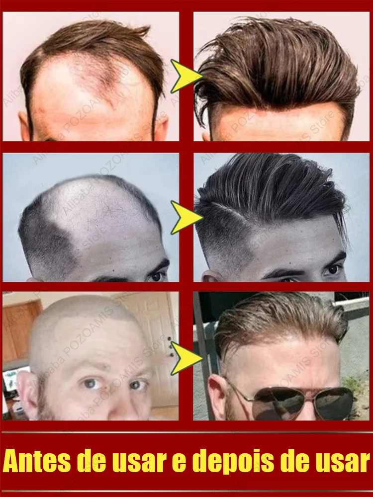 99% of buyers buy again, have more and more hair, say goodbye to baldness, thick hair,Hot selling product