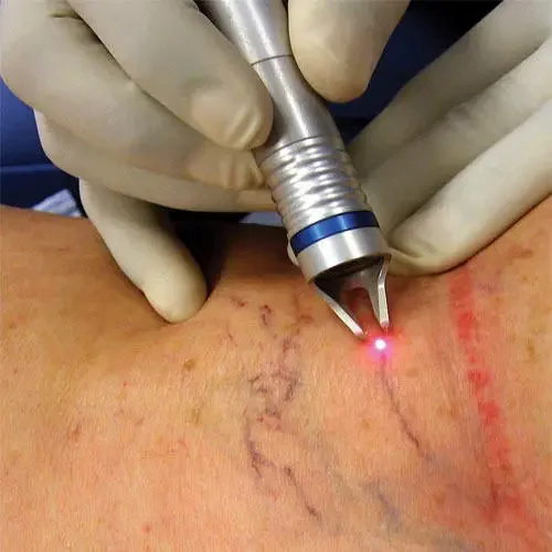 Laser dioda 980nm Untuk penghilang Spider Vein/mesin Laser penghilang vaskuler