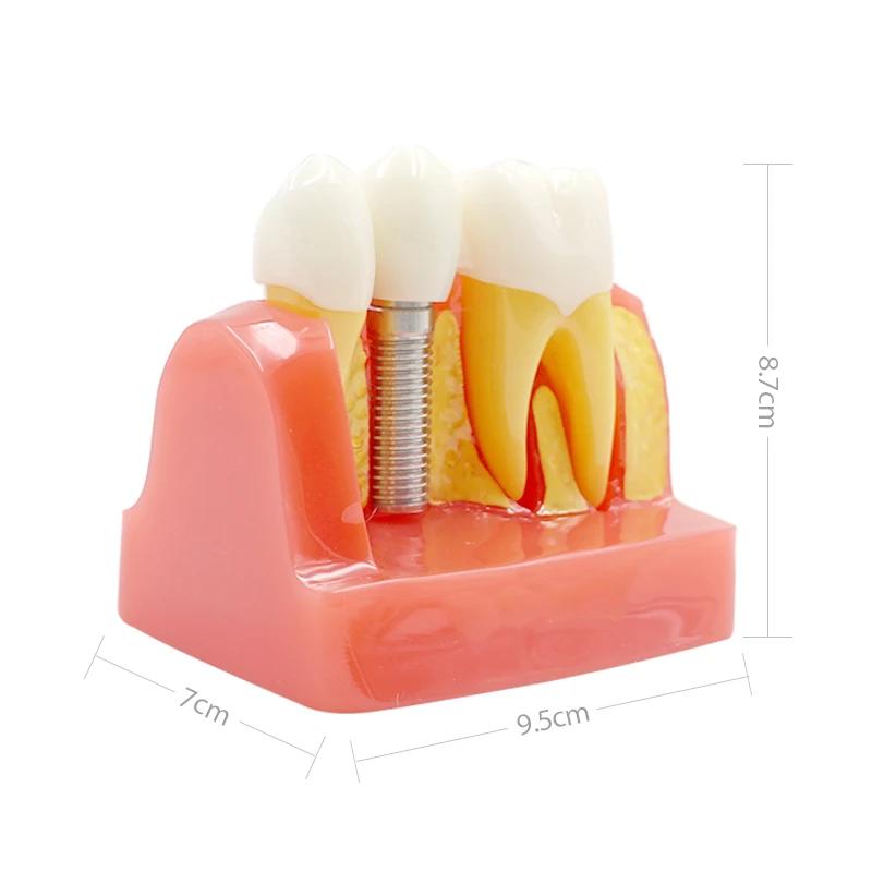 4 Times  Teaching Teeth Model Model Dental Implant  Analysis  Crown Bridge Demonstration Dentist Training Pathology Model