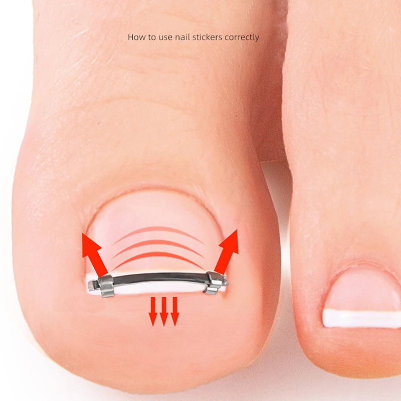 Pedicure Tool Embed Care Correction Ingrown Toenail Toe Nail Straightening Clip Curved Clamp Toenails for Toes