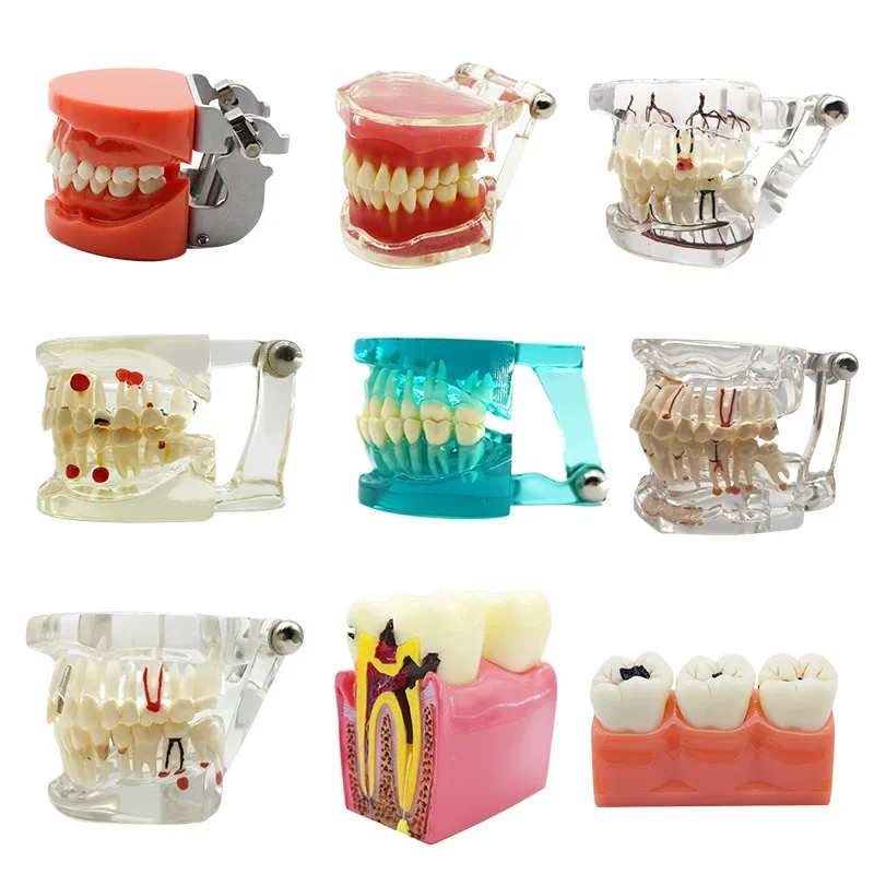 

Dental Implant Disease Teeth Model with Restoration Bridge Tooth Dentist for Medical Science Dental Disease Teaching Study