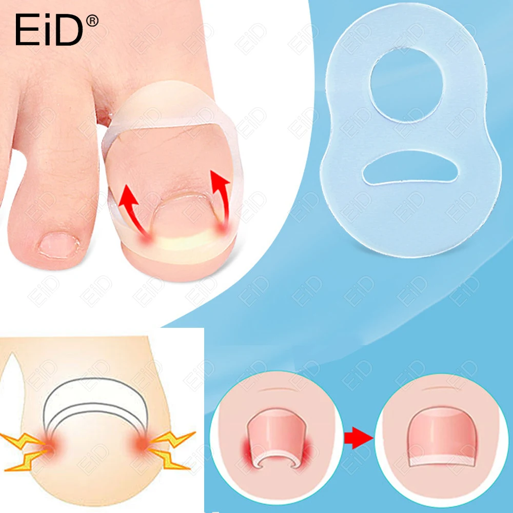 EiD Orthopedic Paronychia Toenail Corrector Strips Anti Nail Patch Feet Sleeping Nail Patch Nails into the Flesh Long Toe Pads