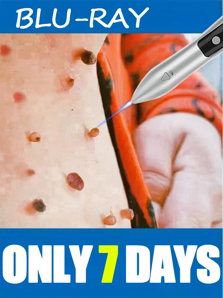 2025년 핫셀링 블루라이트 펜, 베스트셀러 사마귀 치료기. 사마귀 제거 도구.