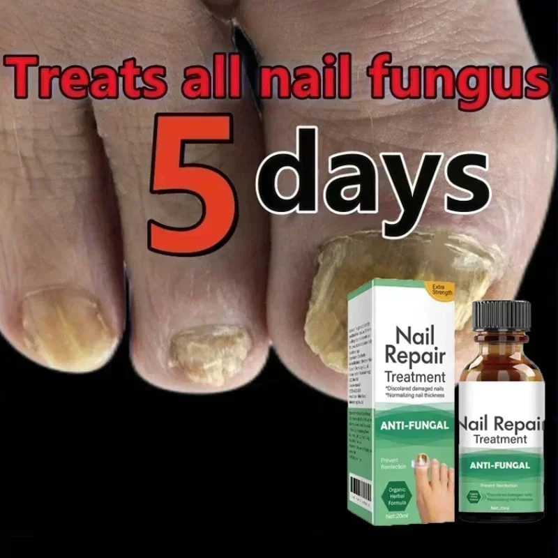 NewToenail Nail Fungus Treatment Repair Fingernail Device Toenail Treatment for Foot Nail Fungus Essential Oil Onychomycosis Ca