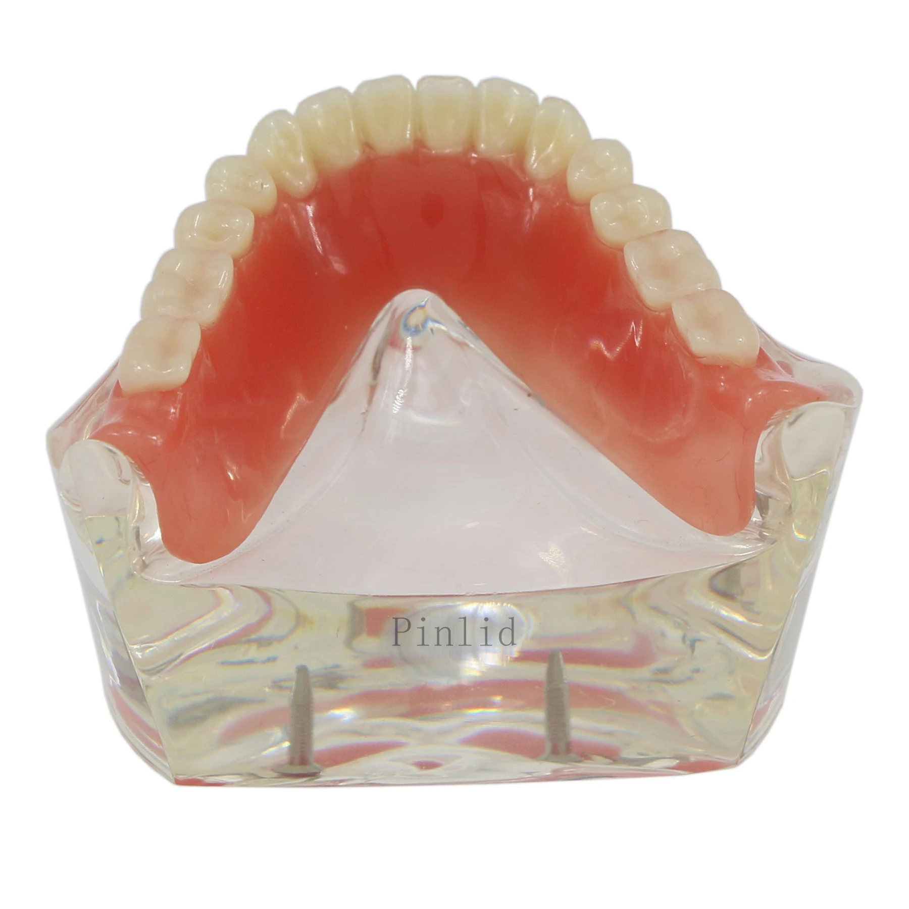 Dental Implant Model Overdenture Inferior 2 Implants Lower Teeth Demo Study M6002