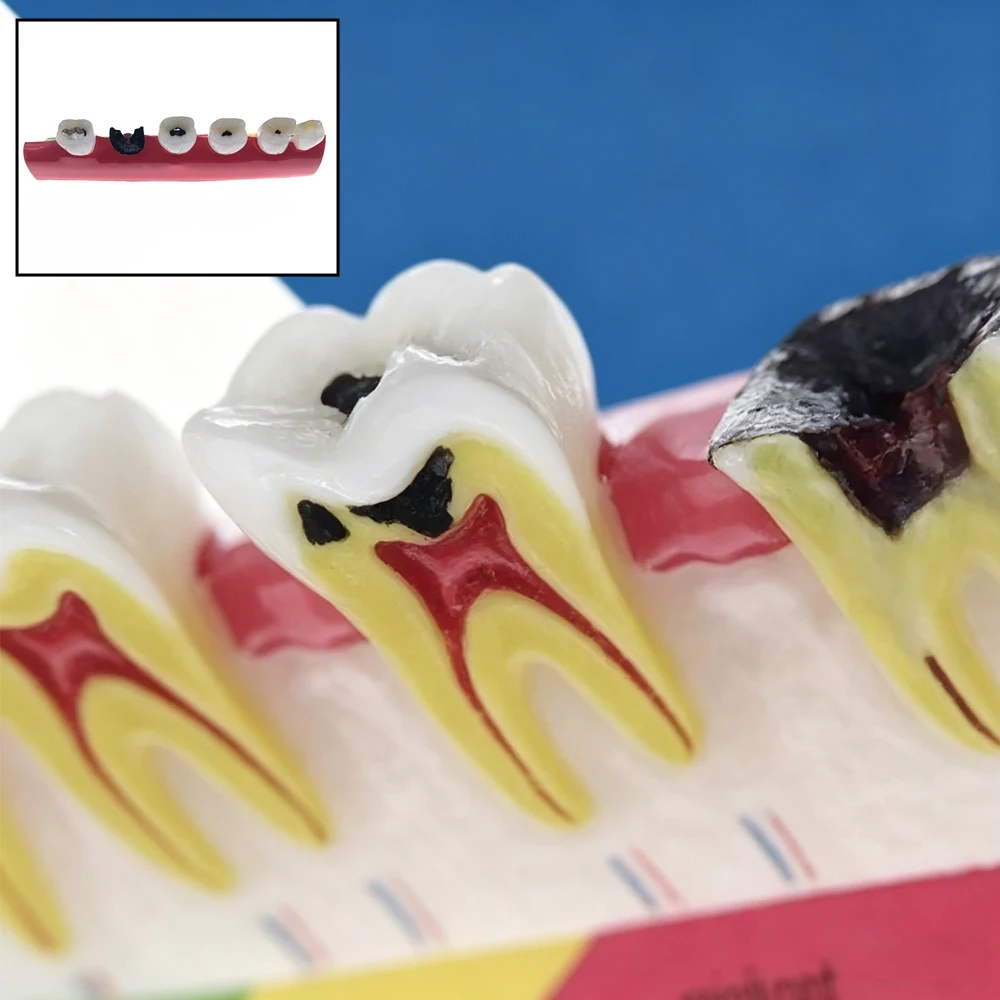 

Dental Caries Classification Tooth Model Showing Pathological Process and Decay Progression