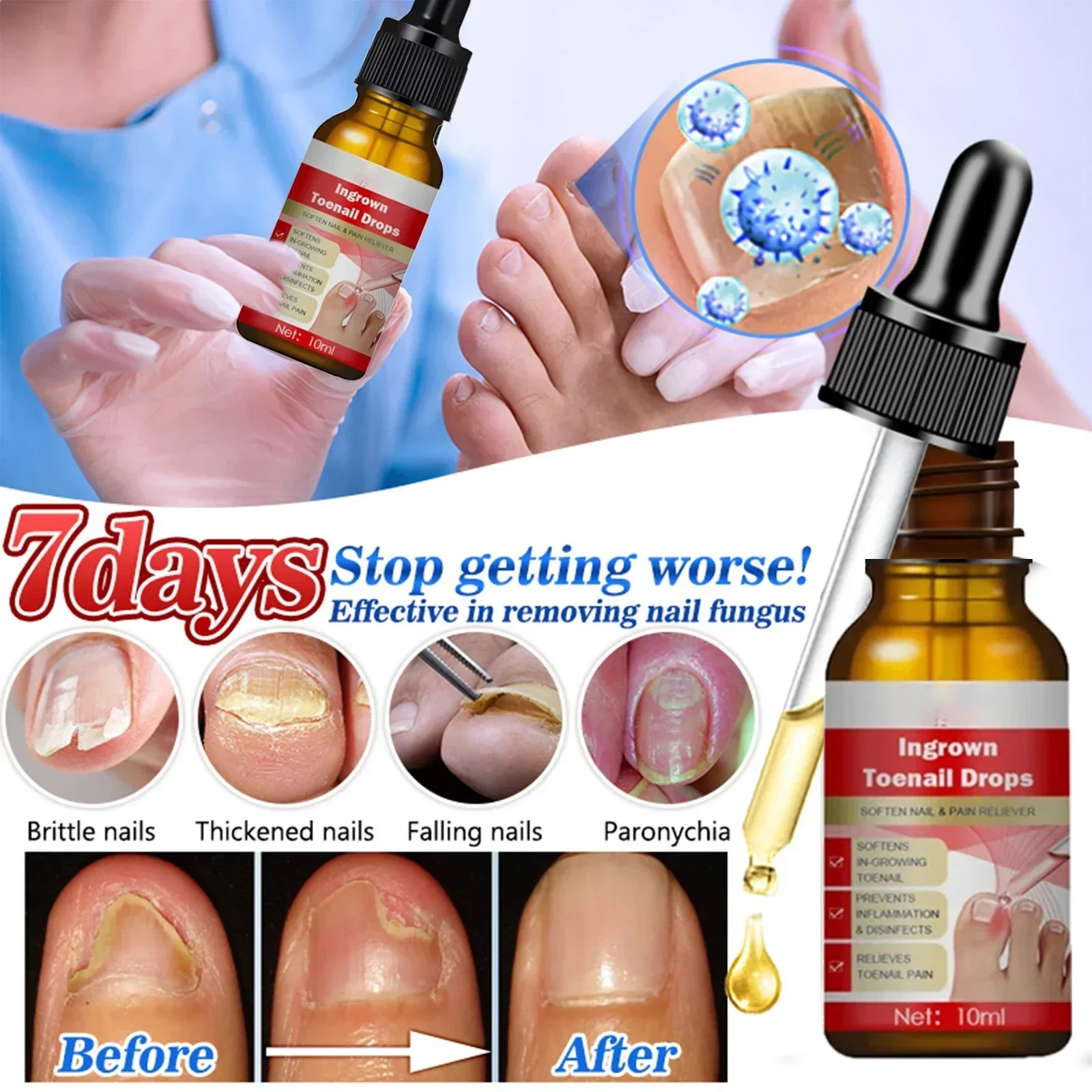 

Nail Fungus Treatment Oil Fungal Treatment Feet Care Essence Anti Infection Paronychia Onychomycosis Ingrown Toenail