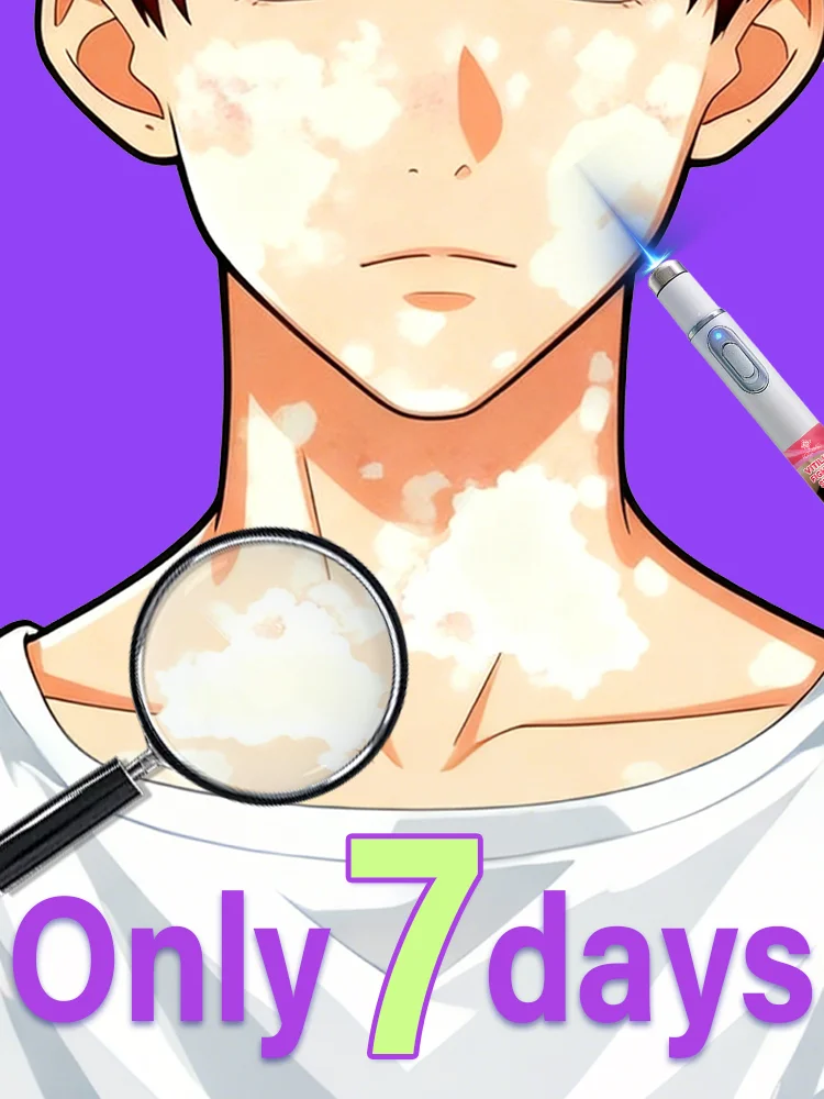 

Generation-2 Laser Says Goodbye To Vitiligo In 7 Days