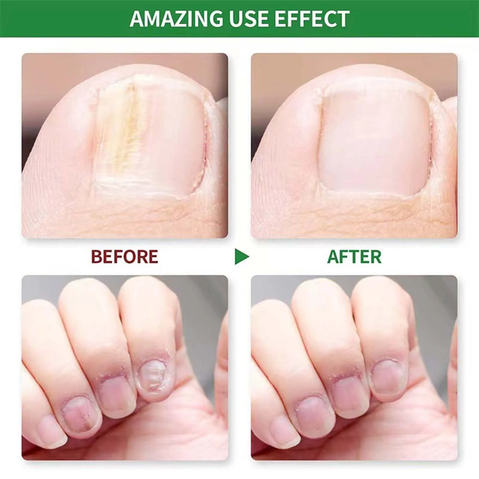 Nail Toenails Care Serum Effective Remove Onychomycosis Nail Repair Liquid for Broken Cracked Split and Weak Nails