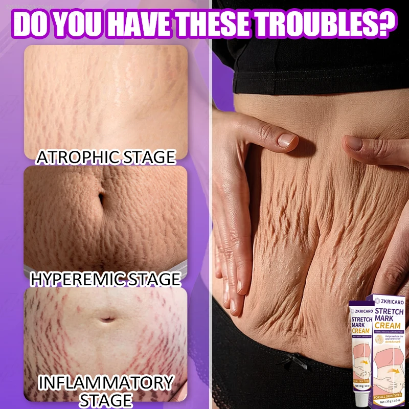 ZKRICARO Body Stretch Mark Cream Nourishing Body Skin Ointment Moisturize Skin Improve Visual Look Of Body Lines Maintain Supple Skin For Postpartum Daily Body Care