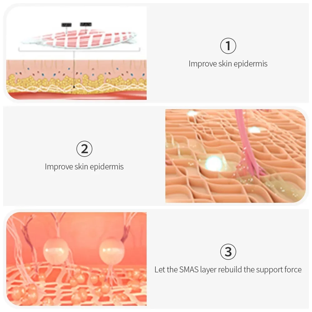 Máquina de beleza focada mini terapia hifu aperto da pele levantamento facial delicado dispositivo de clareamento da pele anti rugas envelhecimento