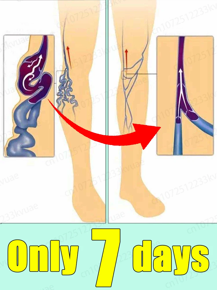 

Say goodbye to varicose veins with this hot-selling foot care tool for just 7 days