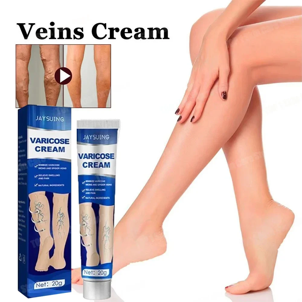 

Varicose vein ointment eliminates vasculitis and relieves spider leg pain