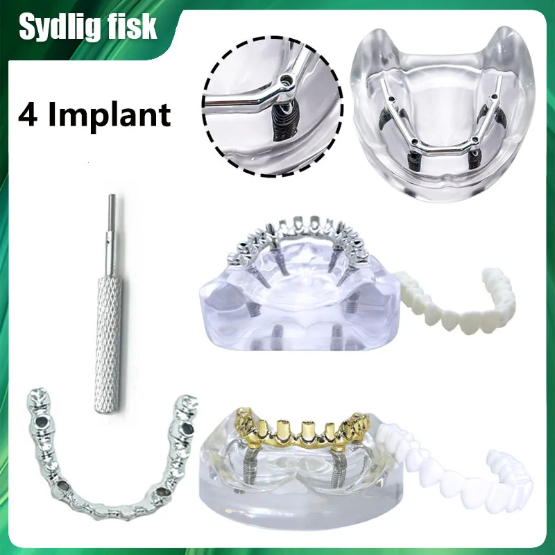 

Dental Implant Model 4 Implants Overdenture Restoration Removable Typodont Implant Teeth Model Dental Oral Teaching Research