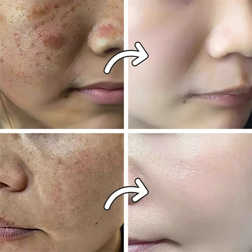 Imagen 2 del producto Suero Facial con vitamina B3, niacinamida, 5% Vitanin E, ácido hipurónico, elimina las manchas negras, pecas, decoloración, melanina, pigmentación, brillo