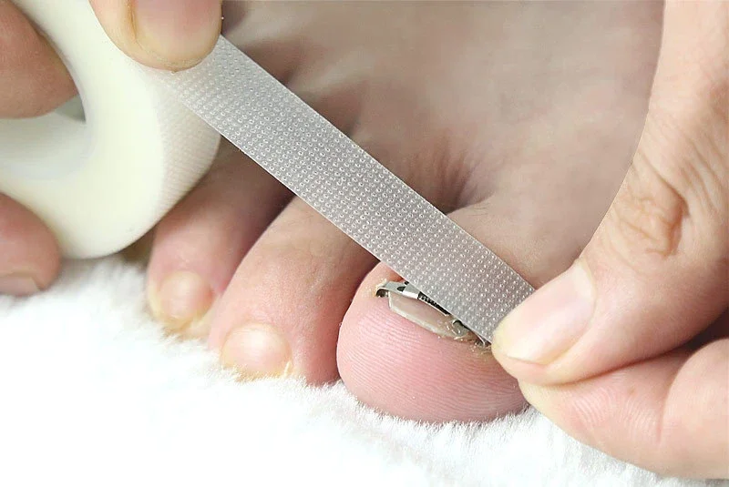 1 ensemble correcteur d'ongle incarné fixateur d'ongle orthopédique traitement de Correction d'ongle outils de soins des pieds outil de récupération intégré