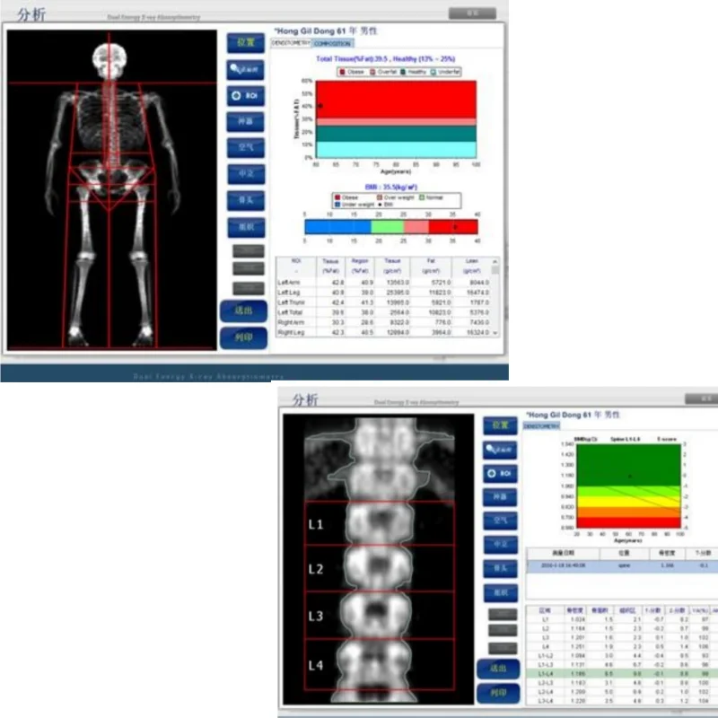 Whole Body Assessment Bone Densitometer with table Medical Rapid Scanning Dual-Energy X-ray Absorptiometry Bone Densitometry