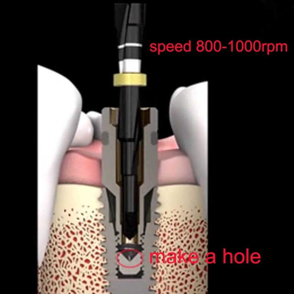 Uchwyt do implantu dentystycznego Złamane złamane śruby Usuwanie urządzeń do implantu Śruby do implantu Narzędzie do burów