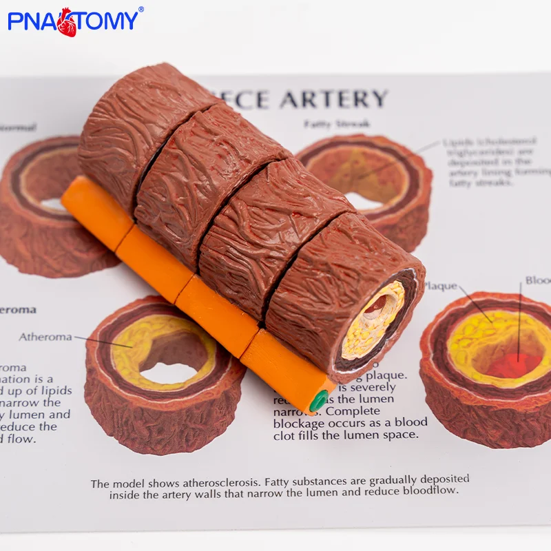 

A Four-stage Arterial Vessel Model Demonstrates the Anatomical Presentation of Vascular Calcification.