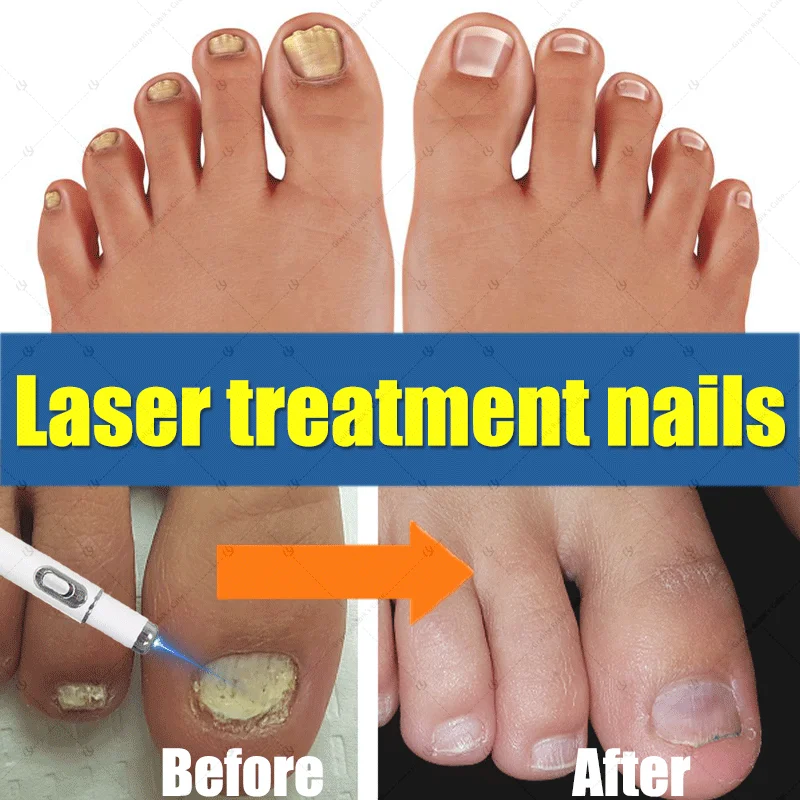 

laser device for nail fungus