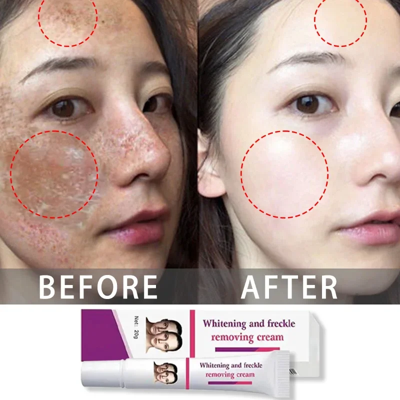 Freckles Removal Cream Remove Facial Spots Skin Dark Spot Remove Melasma Age Spots Sunspots Whitening And Freckle Removing Cream