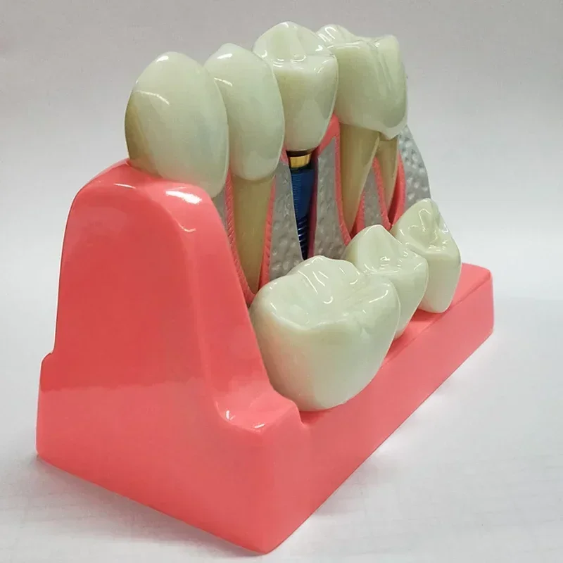 Dental Implant Teach Crown Bridge Removable Model Porcelain Teeth Model Dental Demonstration Model for Dentist Teaching