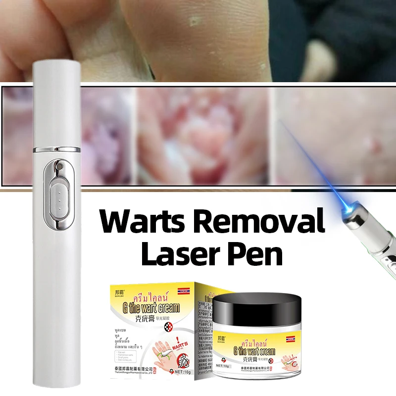 Wart Remover Laser Pen Safe and Effective for Men and Women with Plantar Genital Common Corn Warts