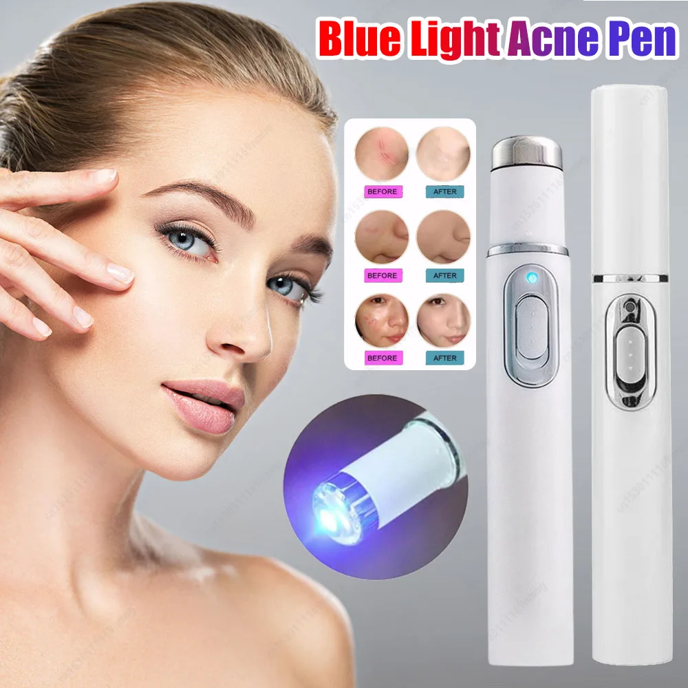 Blue Light Acne Pen Heated Eye Massager Eye Beauty Device for Dark Circles Eye Bags Puffiness Under Eyes
