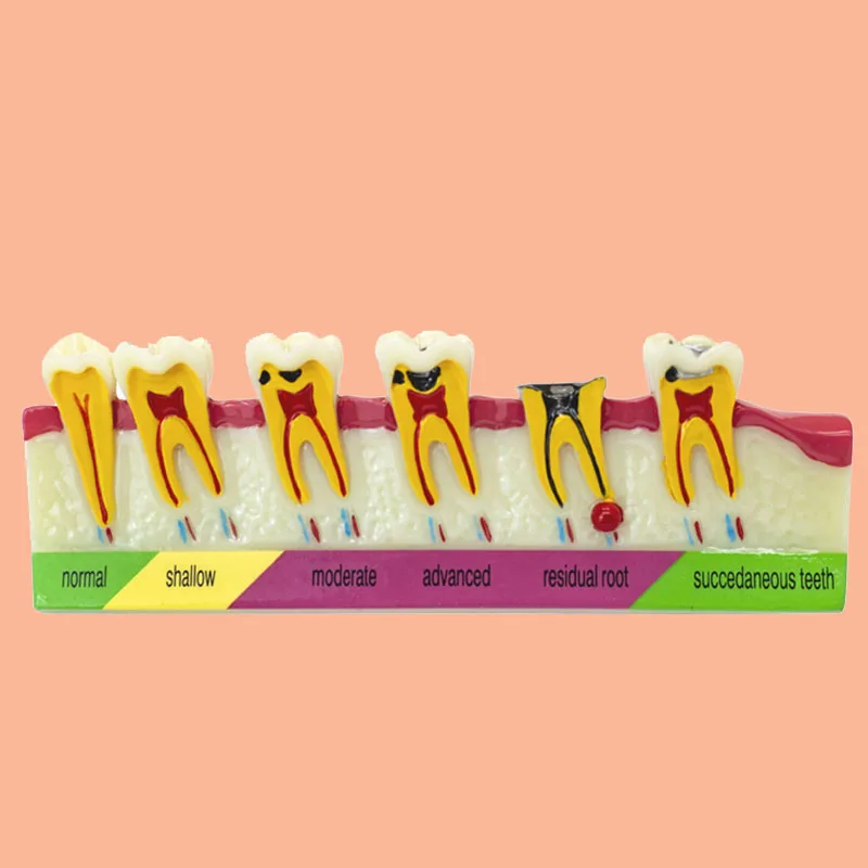 Dental Classify of Pathological Process Around Teeth Caries Evolution Decayed Model