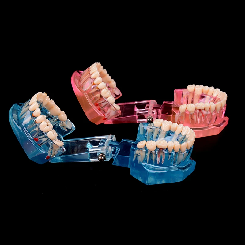 Modelo de dientes con implante Dental para enseñanza médica, cuidado de la salud Oral, ciencia, enseñanza de enfermedades dentales, gran oferta