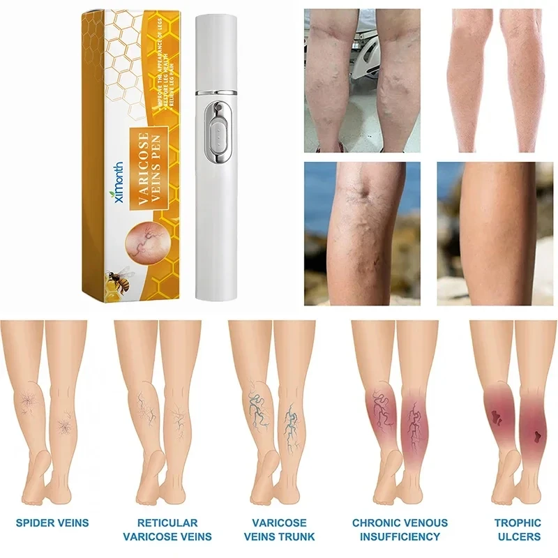 Varicose Veins Laser Therapy Pen For Men And Women Relieve Leg Pain Improves Moderate Varicose Vein Improve Blood Circulation