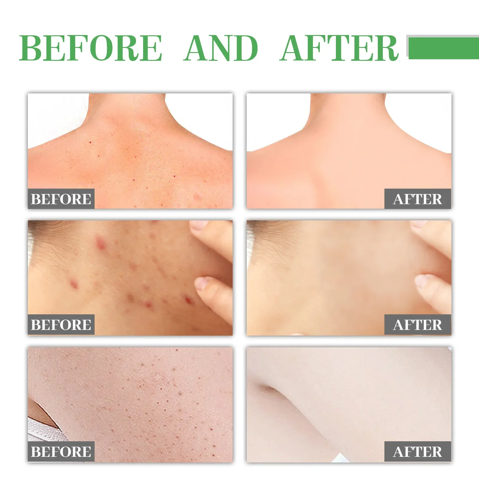 Acne remoção e branqueamento essência, Remover manchas Acne, Acne manchas, Remove manchas Acne, Acne manchas, Acne manchas, Clarear a essência da pele