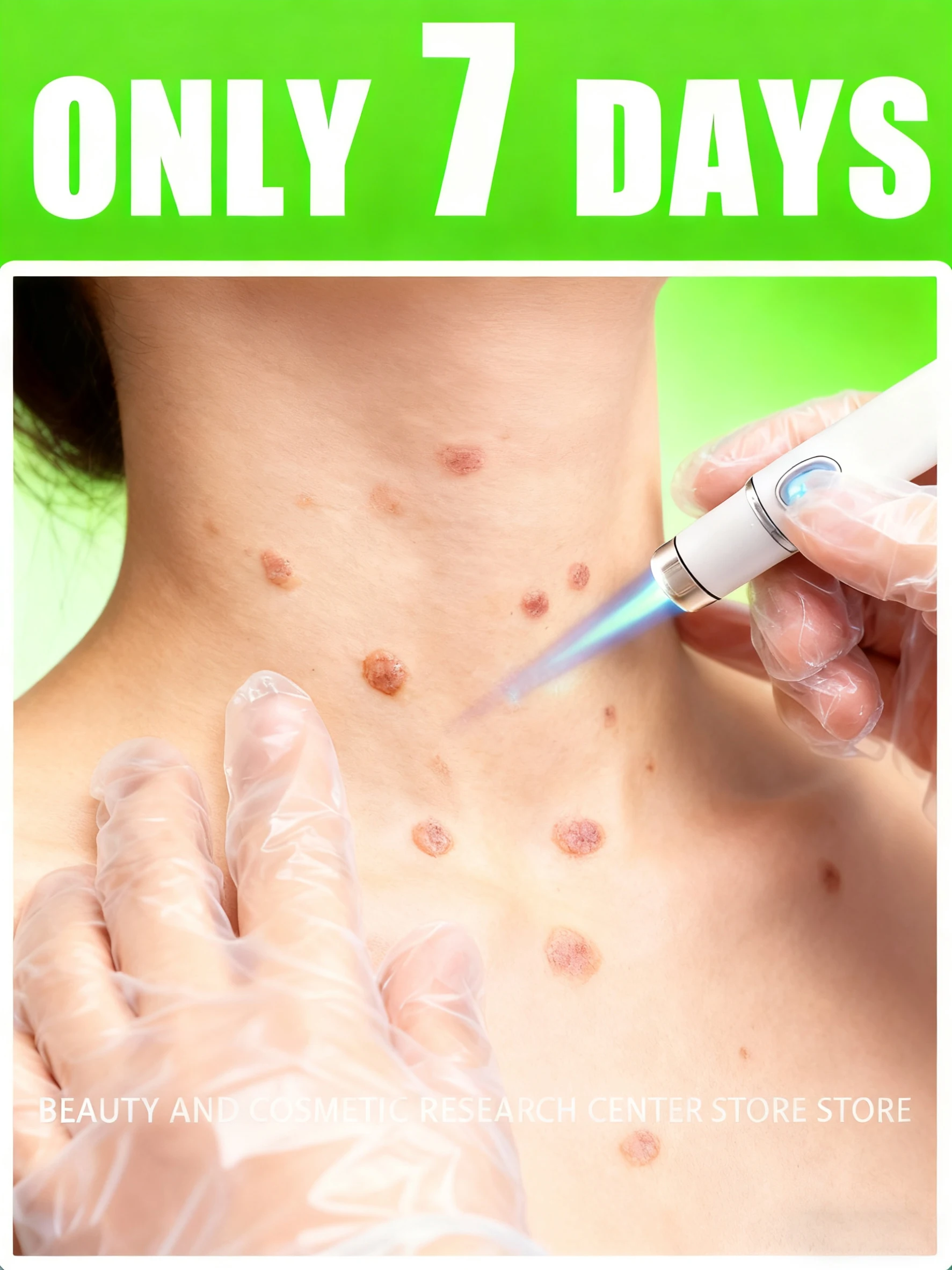 2025 Nueva generación de puntero láser verrugas mejoradas reparación de raíz de verrugas