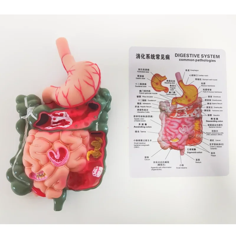 Removerable Human Stomach Anatomy Model Pathological Digestive System Teaching Model with Stomach Section Large Small Intestine