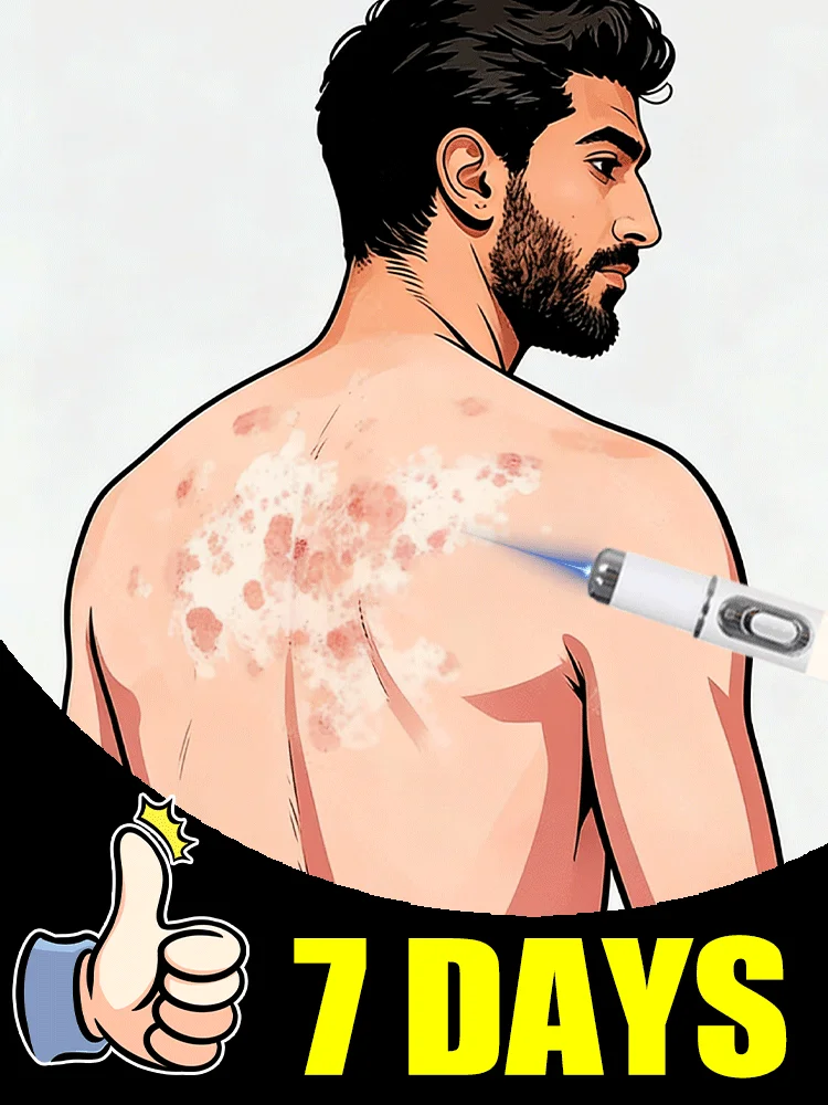 {Fórmula suave} Segunda generación mejorada Vitiligo ⸴ Reparación Vitiligo ⸴ Rápida