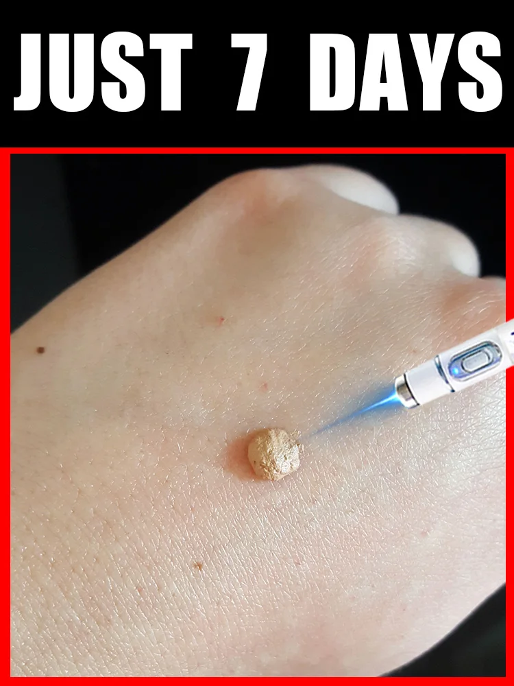 

XUización de herramienta для излучения verrugas con Vissuer azul