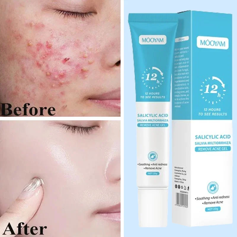 

Acne Cream For Face Pimples Remover Treatment Shrink Pores Oil Control Lighten Acne Marks Whitening Smoothing Facial Skin Care