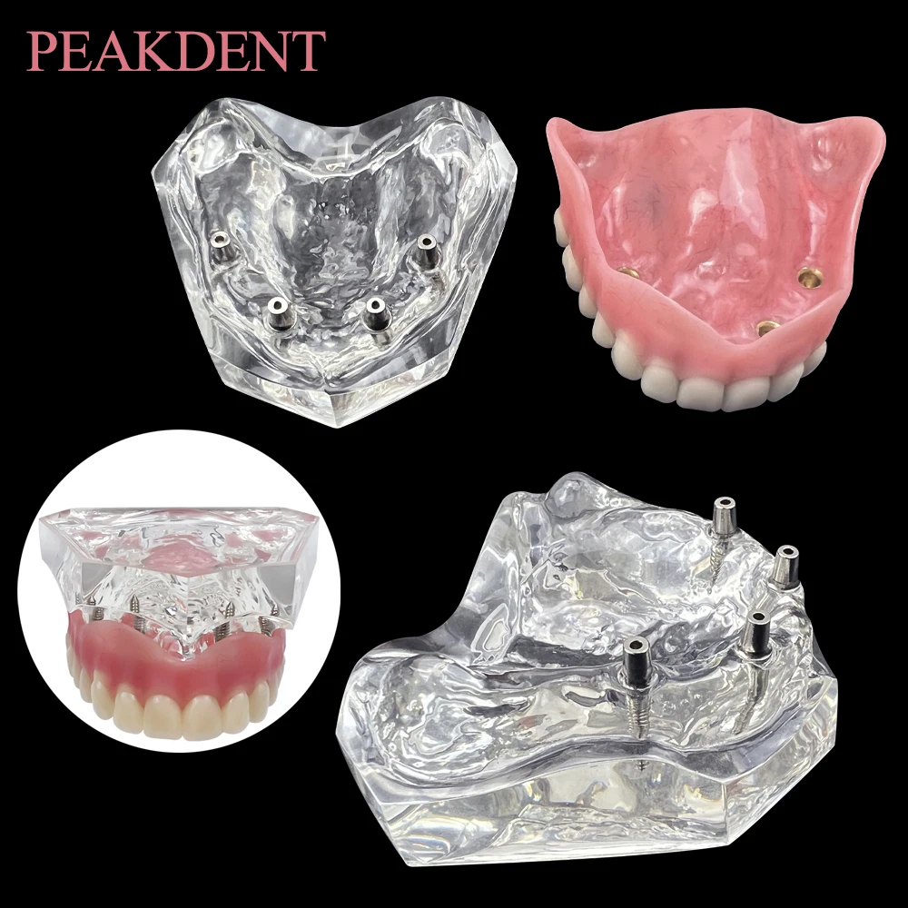 

4-имплантаты, модель для восстановления зубного протеза, модель зубов для стоматологии с прозрачной верхней частью для функции обследования стоматолога