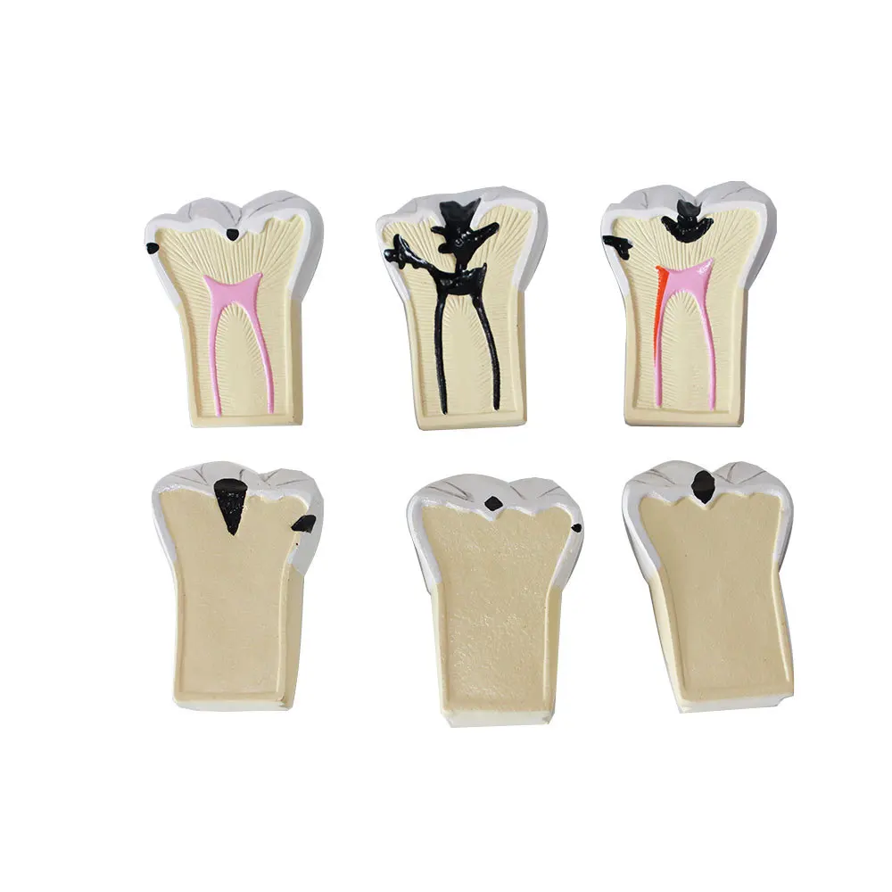 Dental Department: Pediatric Insect Tooth Decay Model, Pathological Caries Anatomy Model
